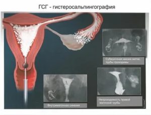 Можно ли при месячных делать гистеросальпингографию