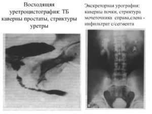 Как образуется стриктура уретры после тур простаты
