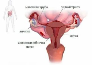 Что делать если сокращается матка при месячных