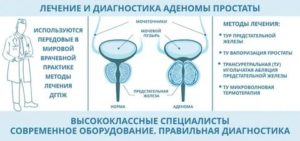 Рикта при аденоме простаты