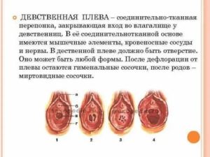 Как восстановить девственную плеву без операций