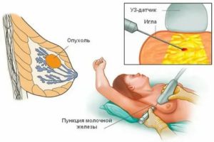 Что делать после пункции кисты молочной железы