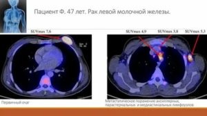 Что такое пэт кт при раке молочной железы