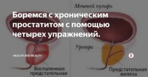 Сколько лет можно прожить с хроническим простатитом
