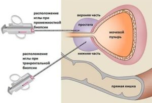 Как делают мультифокальная трансректальная аппаратная биопсия простаты