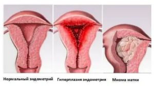 Как выглядит отторгаемый эндометрий во время месячных