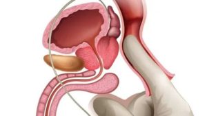 Можно ли при хроническом простатите заниматься оральным сексом