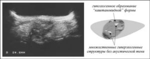 Гиперэхогенное образование в матке это рак
