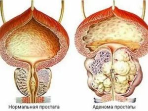 Уринотерапия и лечение аденомы простаты