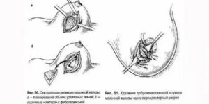 Секторальная резекция молочной железы при раке отзывы пациенток