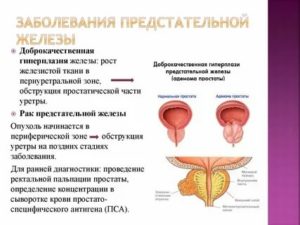 Заболевание предстательной железы у мужчин причины заболевания