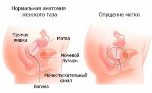 Что такое пластическая операция при выпадении матки