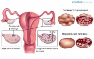 Когда начнутся месячные после лапароскопии яичников при поликистозе отзывы