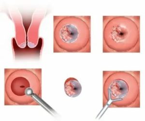 Какие месячные при полипе шейки матки