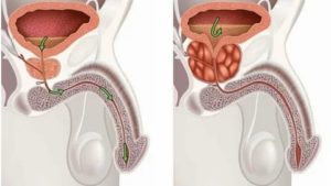 Может ли у женщины быть цистит из за простатита у мужчины