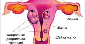 Фиброма матки симптомы и признаки при климаксе