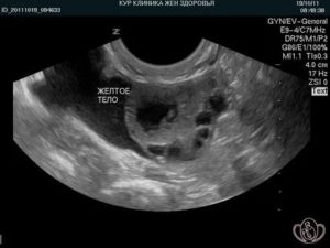 Узи признаки недостаточности желтого тела при беременности