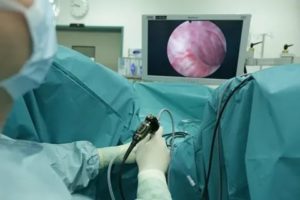 Послеоперационный период после удаления аденомы простаты в больнице и дома