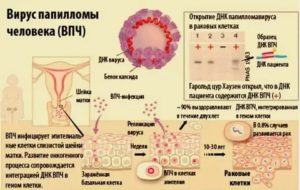 Какая может быть вирусная инфекция шейки матки