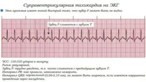 Почему перед месячными сердце сбивается с ритма