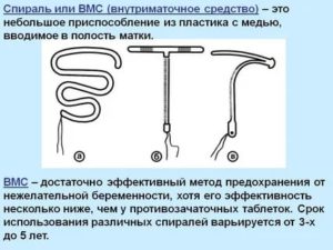 Как подобрать спираль внутриматочную по размеру