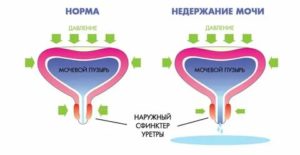 Недержание мочи при простатите и его лечение