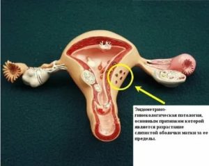 Возможно ли забеременеть после чистки матки при эндометриозе