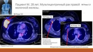 Что такое пэт кт при раке молочной железы