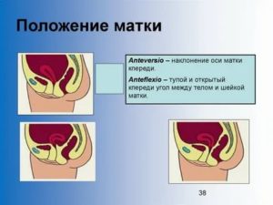 Что означает по узи матка антефлексио что это