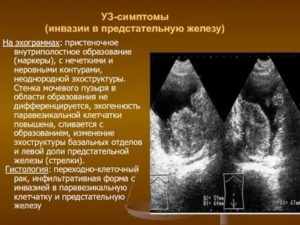 Предстательная железа эхоструктура неоднородная контур четкий