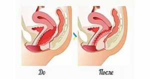 Как уменьшить размер влагалища без операции