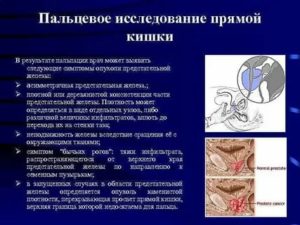 Симптомы рака простаты и прямой кишки