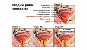 Можно ли жить половой жизнью при раке предстательной железы