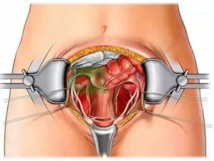 Как завести кишечник после операции по гинекологии