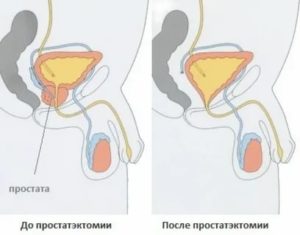 При массаже простаты выделяется моча