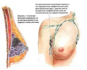 Можно ли находиться на солнце при раке молочной железы