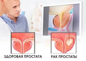 Рак простаты клиника андрос вопросы ответы