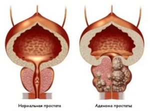 После тур аденомы простаты белые хлопья в моче