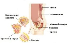 Последствия простатита для мужчин в молодом возрасте
