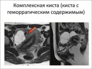 Что такое киста левого яичника с геморрагическим содержимым