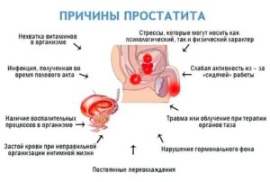 Сколько длится приступ простатита