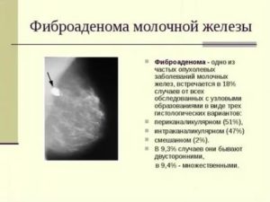 Чем отличается злокачественная опухоль молочной железы от доброкачественной