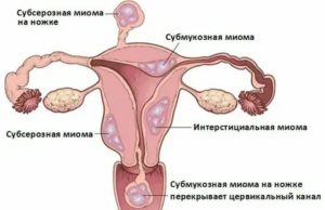 Что принимать при обильных месячных со сгустками при миоме