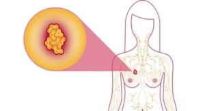 Эндометриоз и рак молочной железы лечение