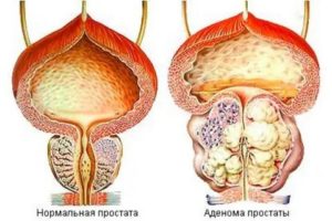 Можно ли париться если аденома предстательной железы