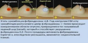 Криоабляция рака молочной железы