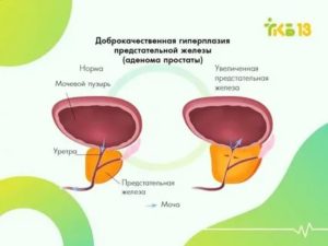 При узи предстательной железы за сколько времени пить воду и сколько