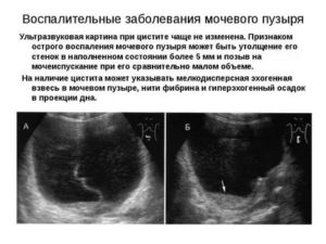 Можно ли выявить цистит по узи