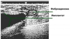 Узи заключение молочной железы с имплантами