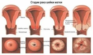 Что такое нулевая стадия рака шейки матки